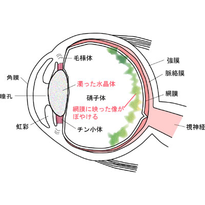 白内障