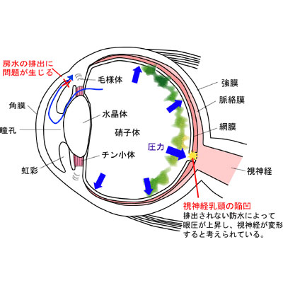 緑内障